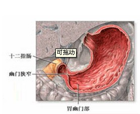 胃溃疡引起幽门梗阻示意图