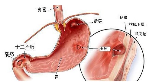 溃疡病复发原因